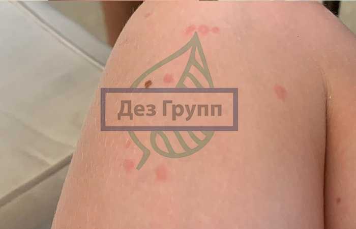 Как выглядит укус кроватного клопа. Смотреть фото Как выглядит укус кроватного клопа. Смотреть картинку Как выглядит укус кроватного клопа. Картинка про Как выглядит укус кроватного клопа. Фото Как выглядит укус кроватного клопа